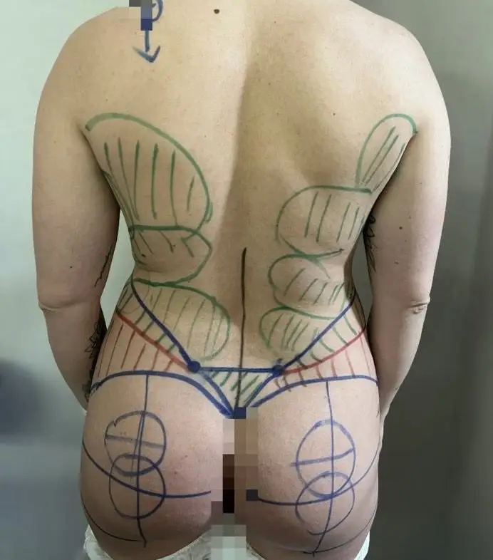 Antes lipomodelación glútea y lipotransferencia